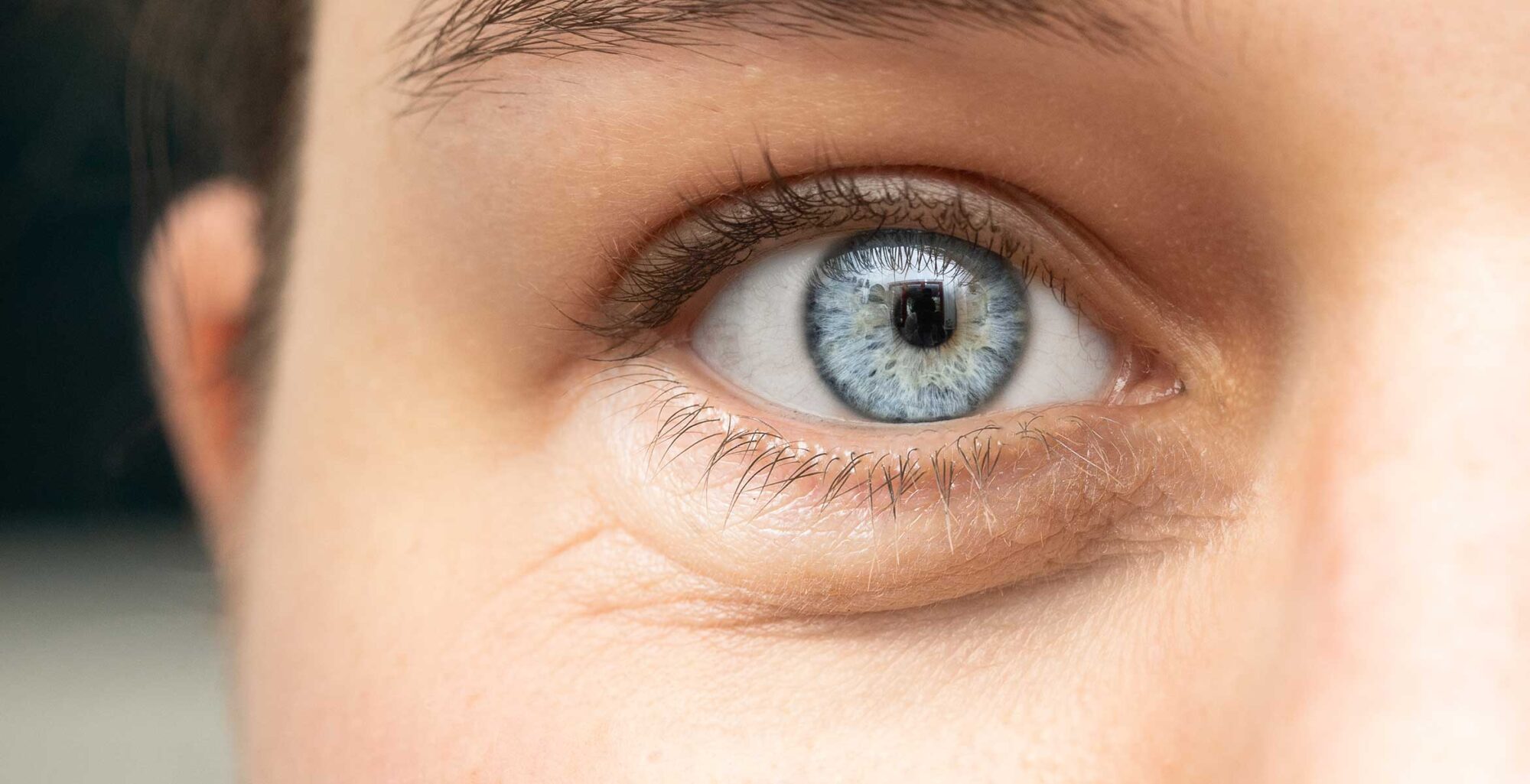 natural ingredients to reduce dark circles