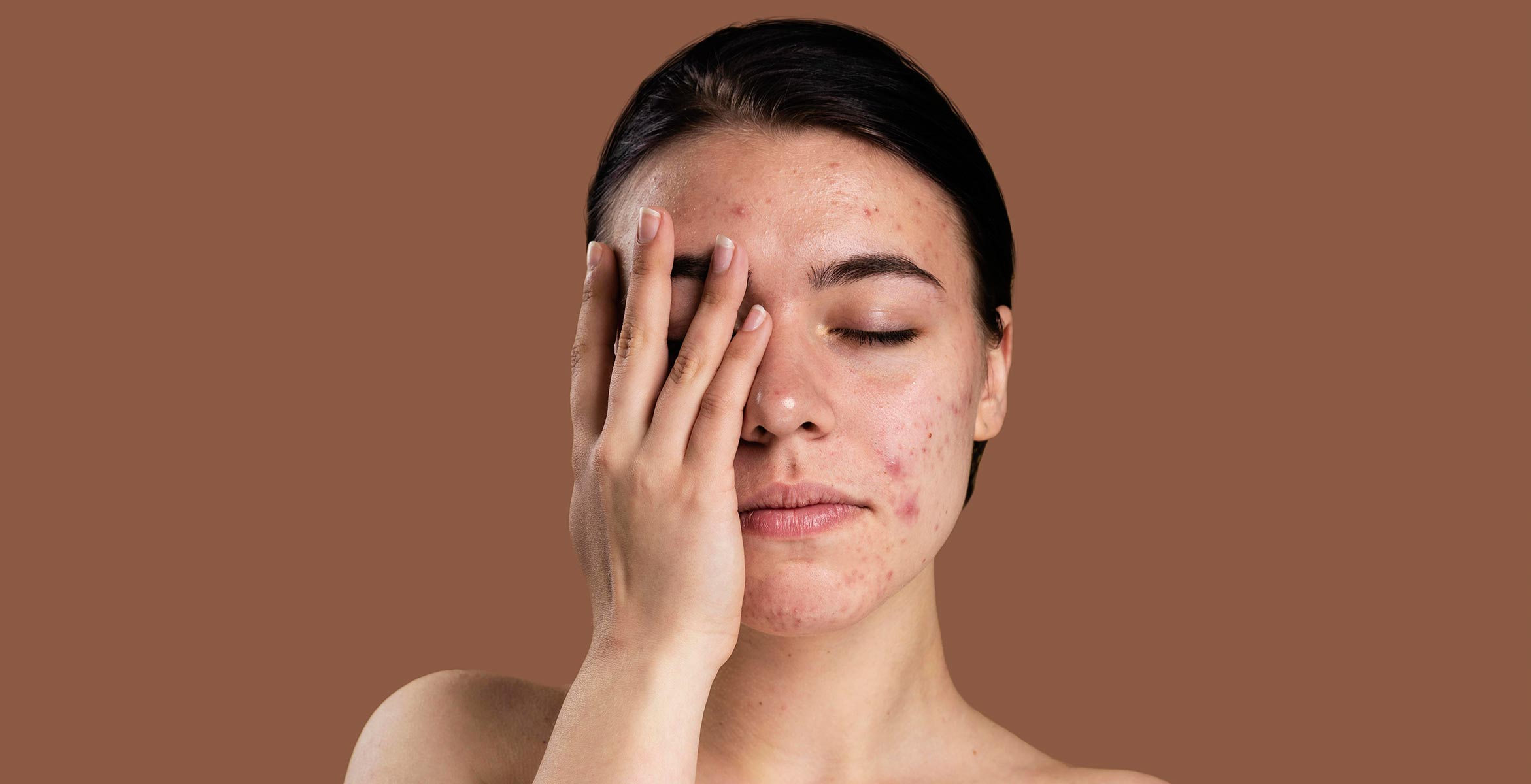 skin purge