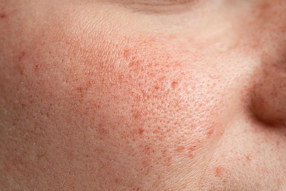 rosacea subtype 1