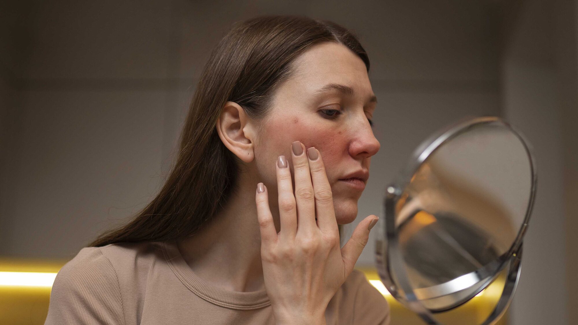 rosacea treatment
