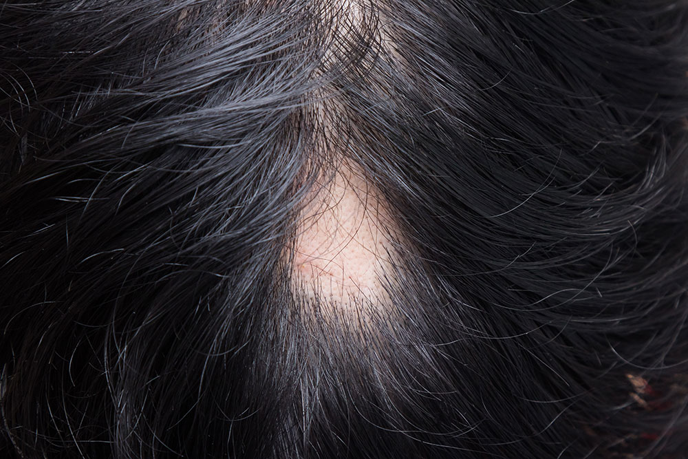 Alopecia: Scalp Care