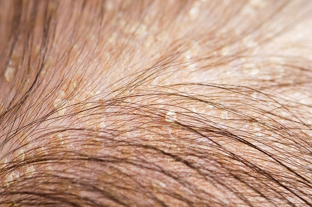 damaged scalp with dandruff