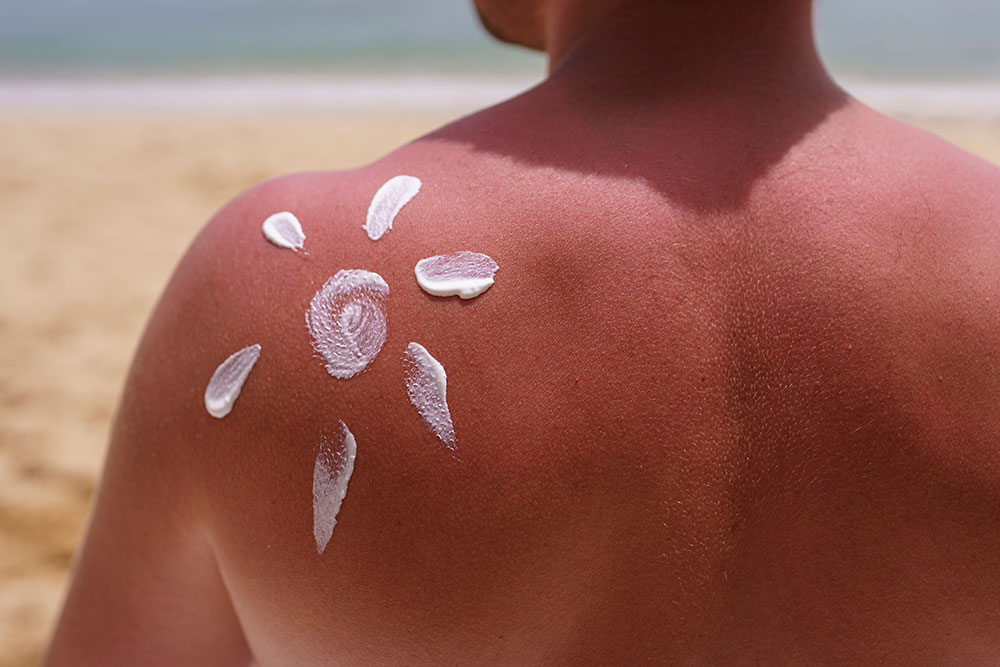 using last year's sunscreen can cause sunburn