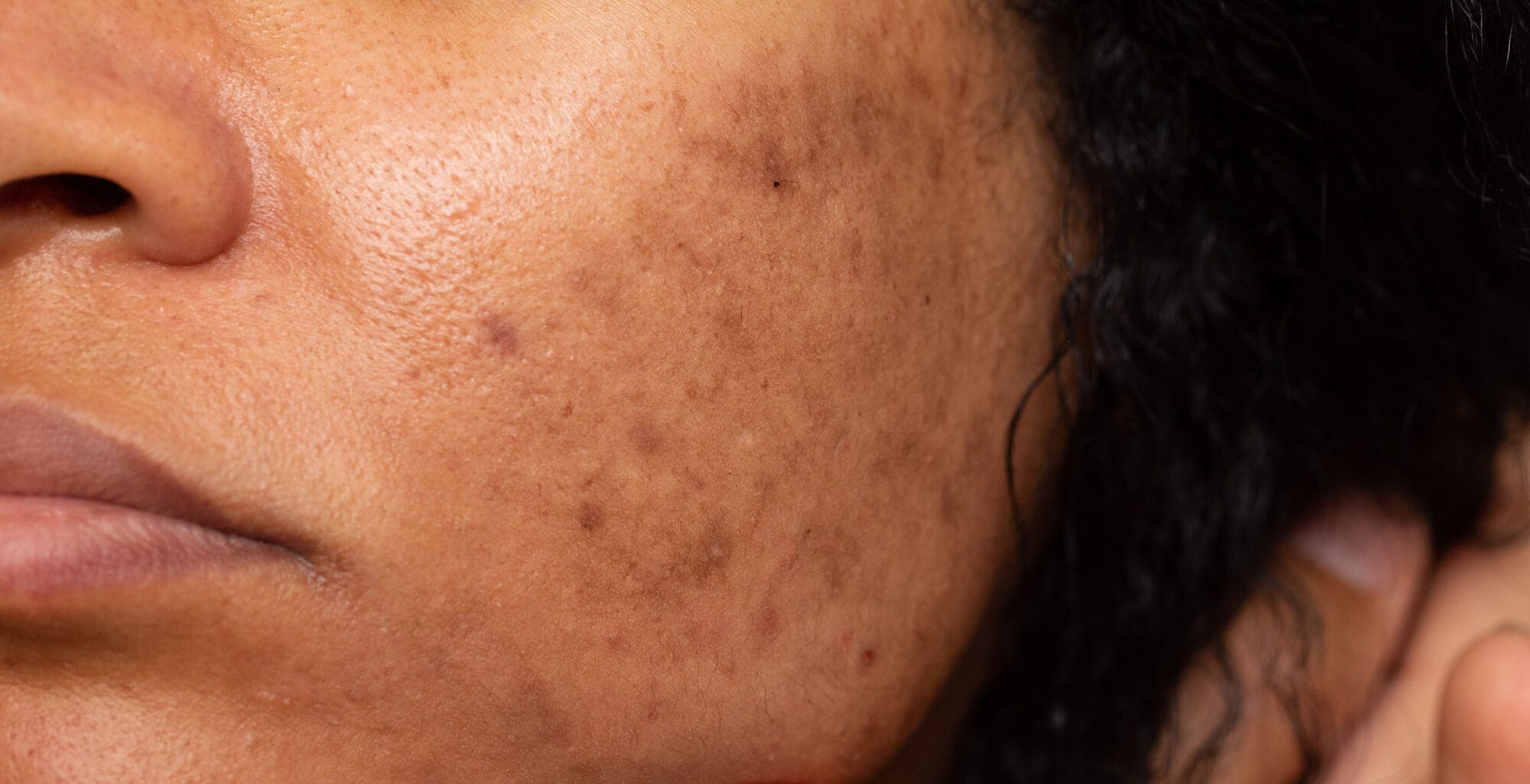 7 Ways to Keep Uneven Skin Tone at Bay This Season