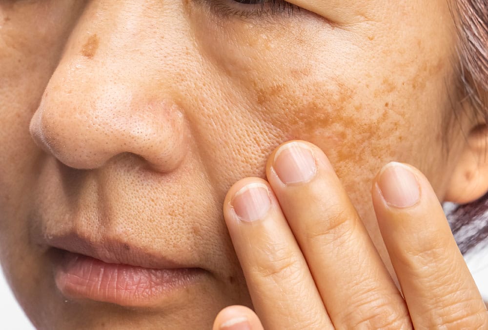 uneven skin tone
