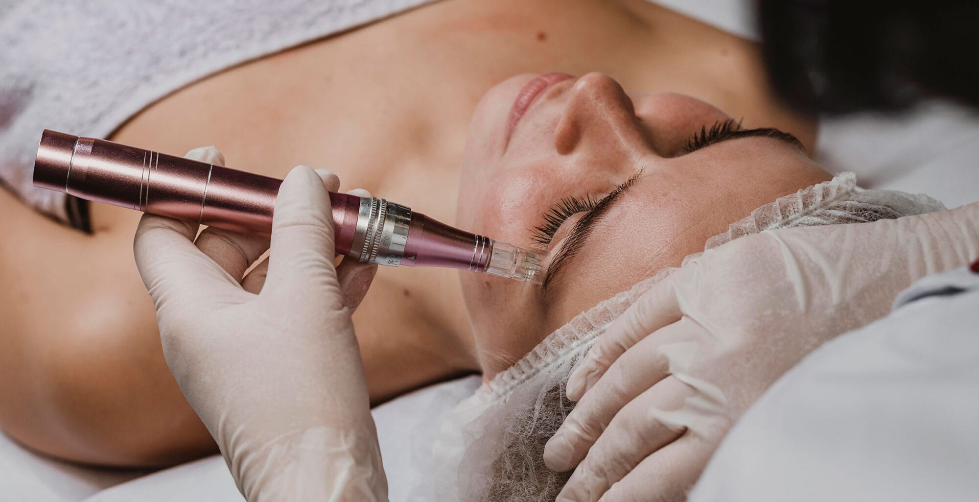 pros and cons of microneedling