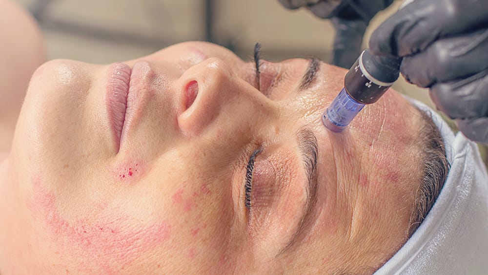 pros and cons of microneedling treatments