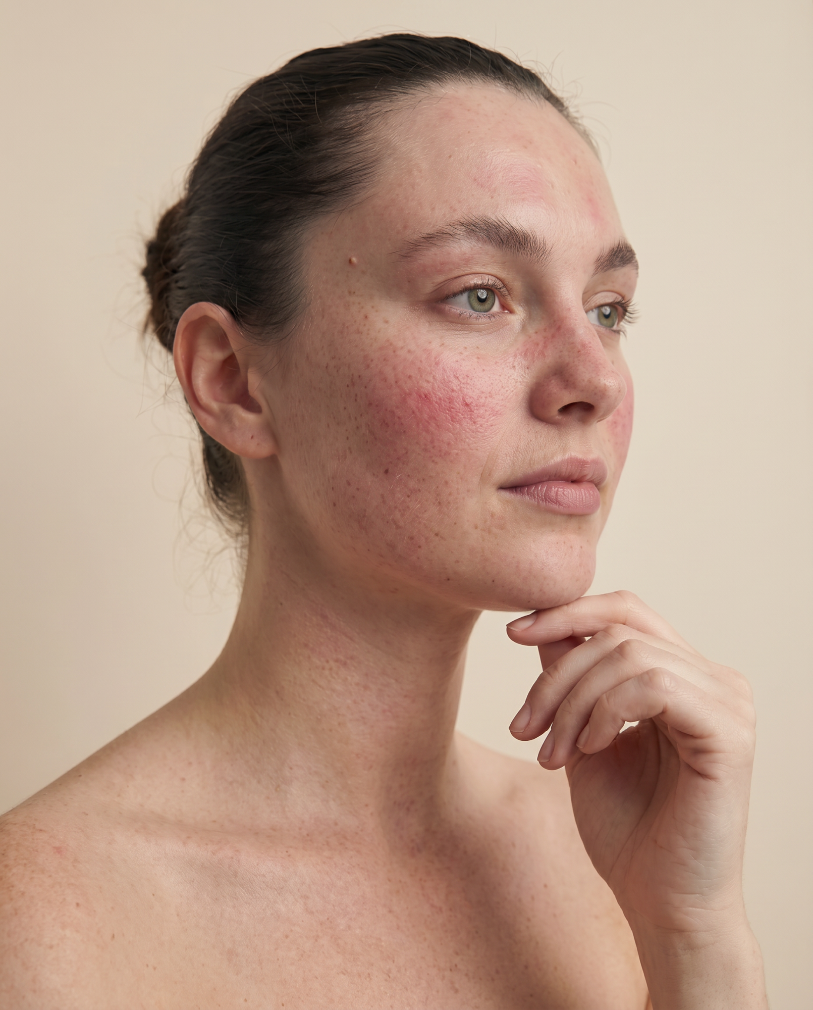 rosacea on the face and redness in sensitive skin